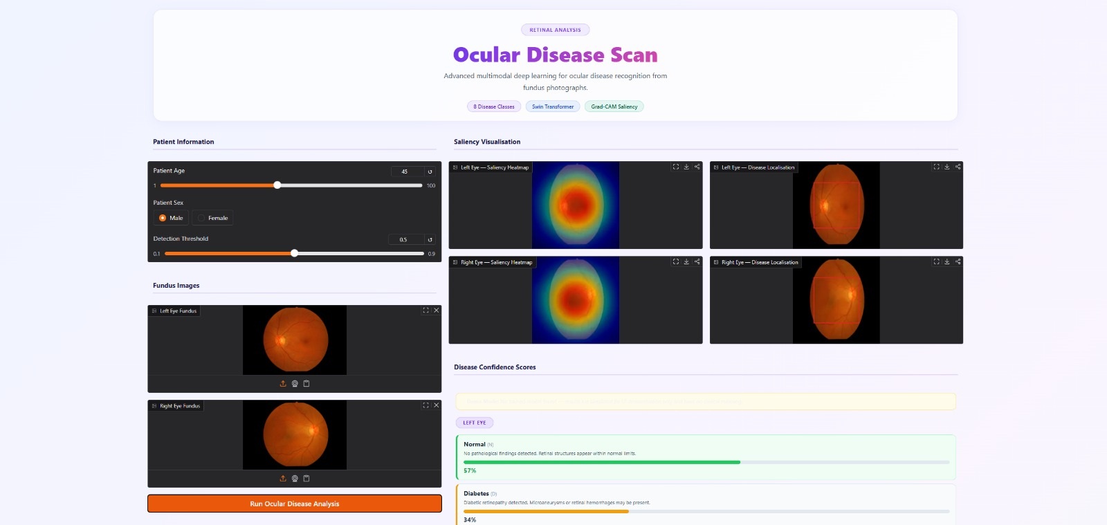 OcuScan Ocular Disease Recognition